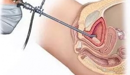 【医疗技术】“无痛”膀胱镜检查，睡眠中发现病灶