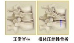 【术后1小时下地行走】我院成功为92岁重度骨质疏松症压缩性骨折患者行手术