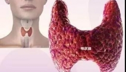 护一“腺”生机——四川省老年病医院（省五医院）开展超声引导下甲状腺细针穿刺活检术