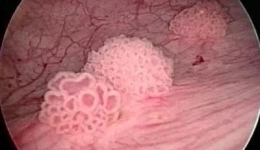 【技术】反复尿血半年，竟然是这个疾病所致