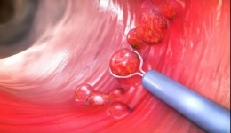 肠镜检查要多久做一次？听听省老年病医院（省五医院）医生的建议