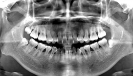 “聪明可靠”的口腔全景CT来喽！赶紧上车来“瞧瞧”~