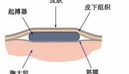 【是谁的心啊！】起搏器——为慢下来的心脏提速