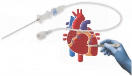 心脏射频消融术，帮您根治心律失常的病根