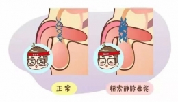 有一种忧伤，是“蛋蛋”的忧伤 ——精索静脉曲张，是哪men 回事