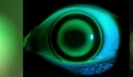 【俊“医”明眼】什么是OK镜