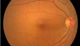 【“俊”医明眼】都知道脑中风，你了解“眼中风”吗？严重可致失明