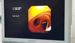 【讲肺话】吸入性肺炎 或成为高龄患者的隐形杀手