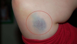 【吾愿讲您听第十期】无缘无故出现淤青?小心背后有大危险!