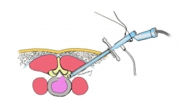 【医疗技术】6毫米“钥匙孔” 巧摘“老腰突”