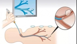 【讲“肺”话】无需再“忍”，无痛纤维支气管镜，您的安心选择