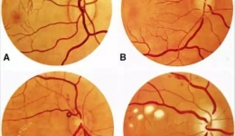 【“俊”医明眼】罗主任告诉你——眼底检查有多重要