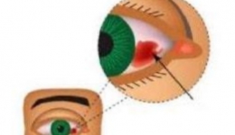 【“俊”医明眼】“可怕”的眼睛出血——结膜下出血