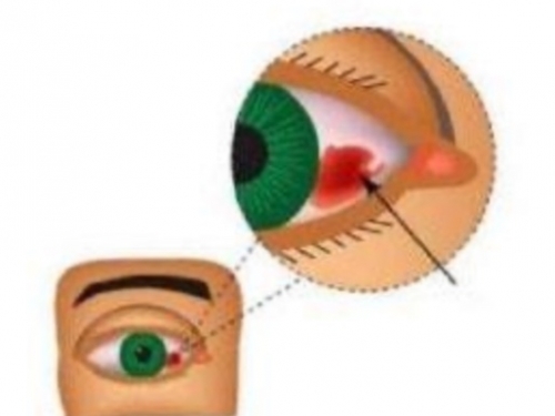 【“俊”医明眼】“可怕”的眼睛出血——结膜下出血