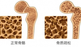 【药知道】药物治疗骨质疏松症，不只多补钙