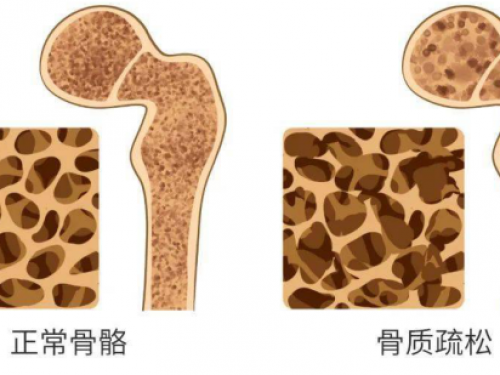 【药知道】药物治疗骨质疏松症，不只多补钙