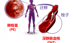 四川省老年病医院（省五医院）启动静脉血栓栓塞症（VTE）防治能力项目建设
