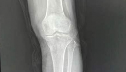 【医疗技术】让患者再次“健步如飞”——人工全膝关节置换术