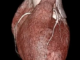 【医学影像技术】冠脉CTA三维立体图像，读懂您的“心”病