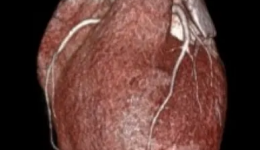 【医学影像技术】冠脉CTA三维立体图像，读懂您的“心”病