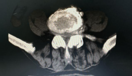 【华西领办】华西疼痛科专家带队治疗90岁高龄老人“腰椎管狭窄症”