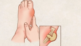 【健康科普】警惕中老年人“第四高”——高尿酸