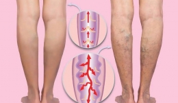 【健康科普】不开玩笑！这样打麻将，小心下肢静脉曲张找上门