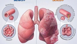 【健康科普】老年慢阻肺患者，咋个过冬？