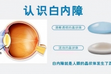 【健康科普】白内障不是水果，千万别等它“熟透”了才摘！