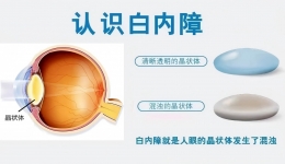 【健康科普】白内障不是水果，千万别等它“熟透”了才摘！