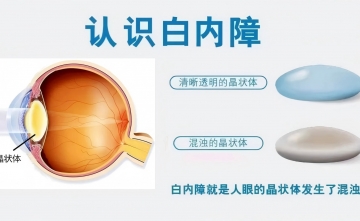 【健康科普】白内障不是水果，千万别等它“熟透”了才摘！