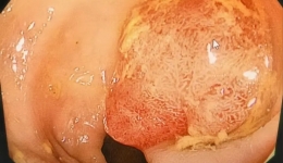 【老年诊疗技术】84岁老人结肠巨大息肉如何“无创”解决？内镜下尼龙绳套扎术了解一下