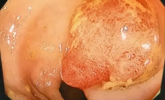 【老年诊疗技术】84岁老人结肠巨大息肉如何“无创”解决？内镜下尼龙绳套扎术了解一下