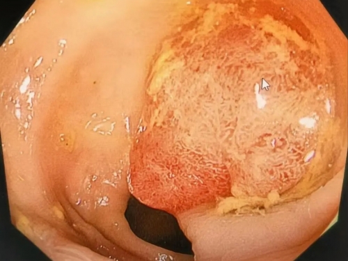 【老年诊疗技术】84岁老人结肠巨大息肉如何“无创”解决？内镜下尼龙绳套扎术了解一下