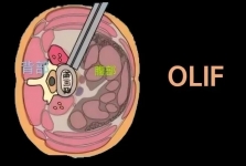 【工作动态】我院成功开展首例斜外侧腰椎椎间融合术，微创技术开启脊柱治疗新篇章！
