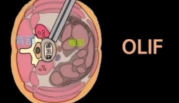 【工作動態(tài)】我院成功開展首例斜外側腰椎椎間融合術，微創(chuàng)技術開啟脊柱治療新篇章！