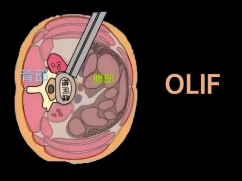 【工作动态】我院成功开展首例斜外侧腰椎椎间融合术，微创技术开启脊柱治疗新篇章！