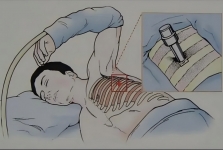 【诊疗技术】内科胸腔镜：一个“小孔”解决大问题