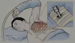 【诊疗技术】内科胸腔镜：一个“小孔”解决大问题