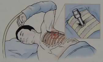 【诊疗技术】内科胸腔镜：一个“小孔”解决大问题