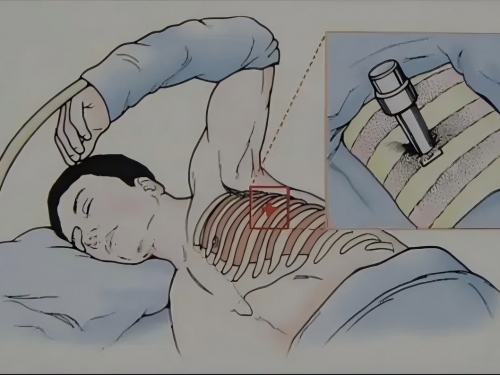 【诊疗技术】内科胸腔镜：一个“小孔”解决大问题