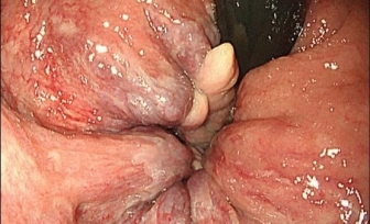 【特色诊疗技术】内镜下内痔套扎术——帮您远离内痔困扰